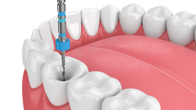 Root canal therapy diagram explanation