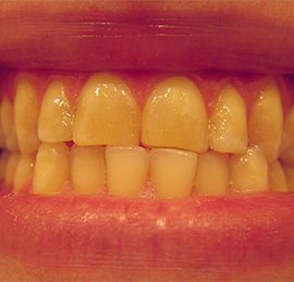 bruxism photo