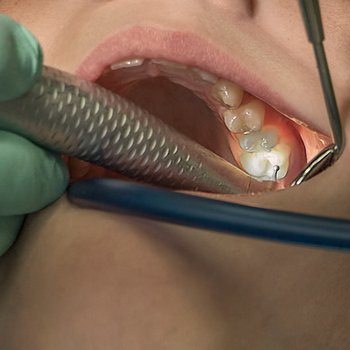 how to overcome dental anxiety