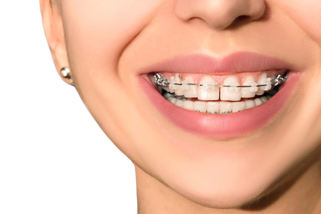 affordable clear braces near you