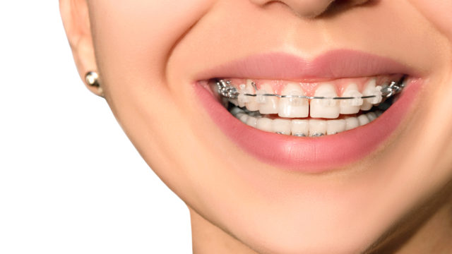 affordable clear braces near you