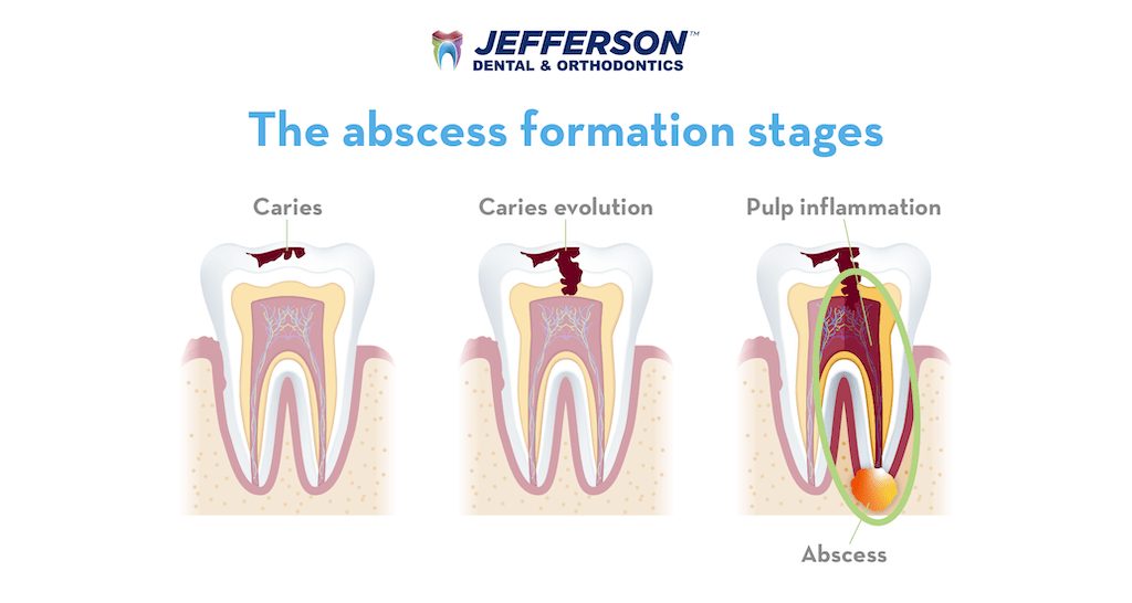 Abscess formation stages illustration