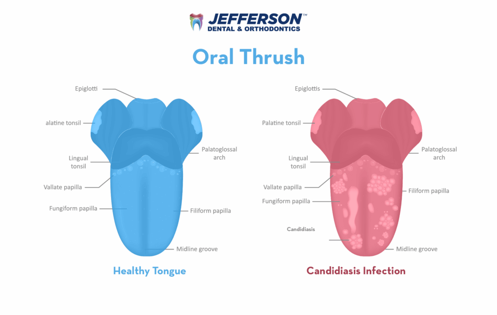 How Do You Cure A Yeast Infection On Your Tongue