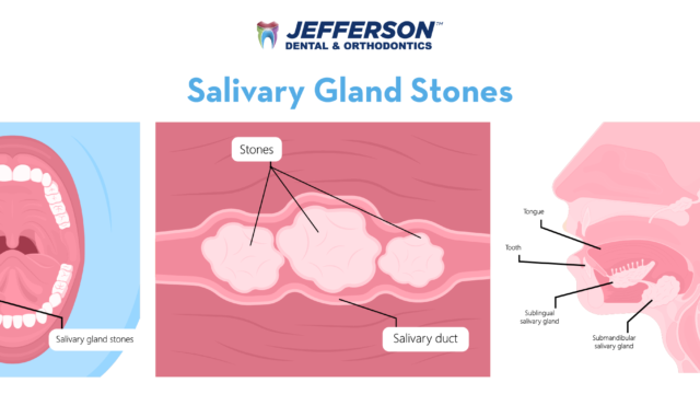 Salivary Gland Stones
