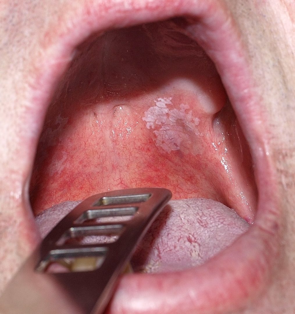 what are the risks of smokeless tobacco Smokeless Tobacco