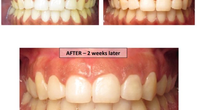 Gingivectomy before and after images