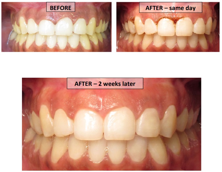 Gingivectomy before and after images