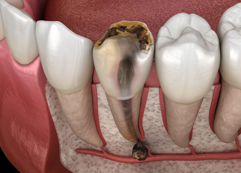 Dead Tooth: Causes, Symptoms & Treatment | Jefferson Dental & Orthodontics