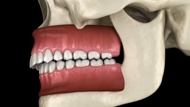 overbite illustration