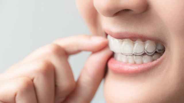 diy_at_home_clear_aligners